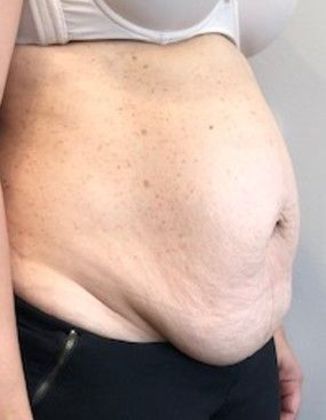 Tummy Tuck: Case 19 - Tummy Tuck with Liposuction, Norwalk, CT - Before