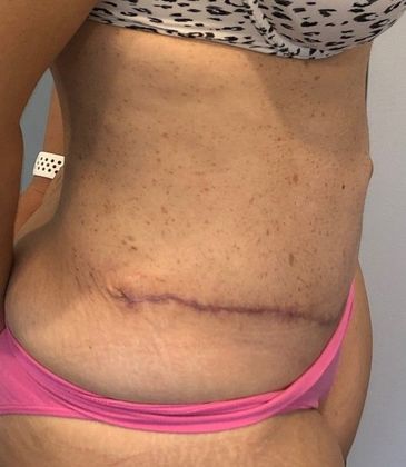 Tummy Tuck: Case 19 - Tummy Tuck with Liposuction, Norwalk, CT - After