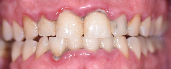 Periodontal Cleaning: Case 1 - Victoria, TX - Before