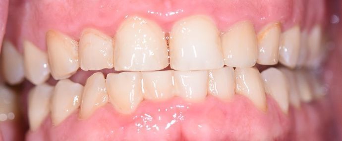 Periodontal Cleaning: Case 1 - Victoria, TX - After