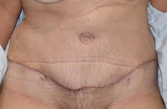 Tummy Tuck (Abdominoplasty): Case 204 - After