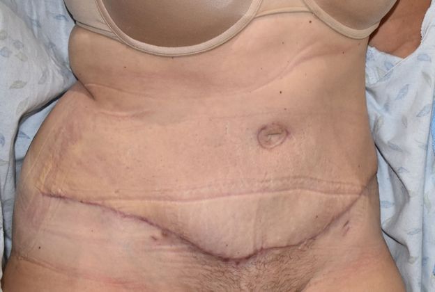 Tummy Tuck (Abdominoplasty): Case 204 - After
