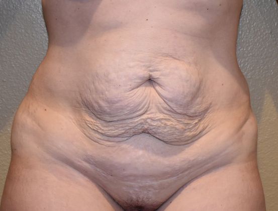 Tummy Tuck (Abdominoplasty): Case 204 - Before