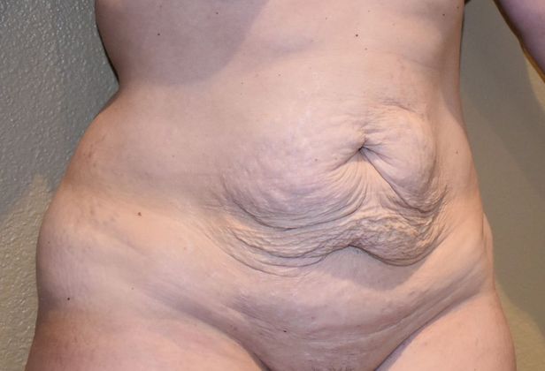 Tummy Tuck (Abdominoplasty): Case 204 - Before