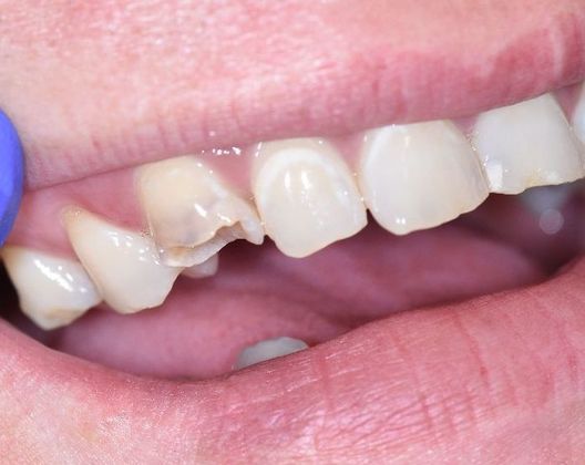 Tooth-colored Fillings: Case 8 - Seadrift, TX - Before