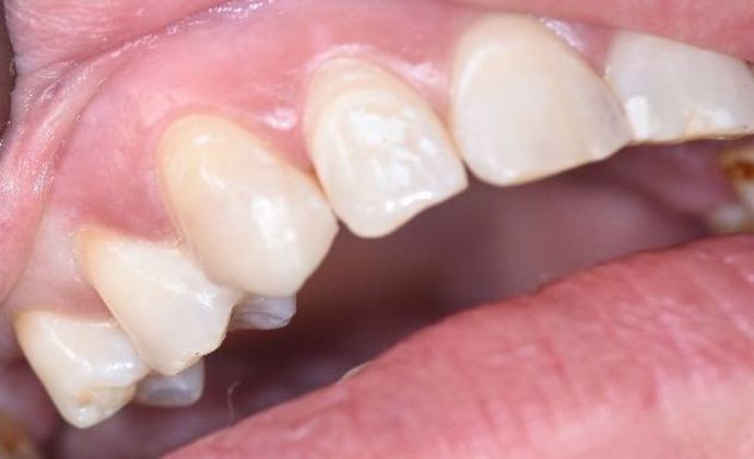 Tooth-colored Fillings: Case 8 - Seadrift, TX - After