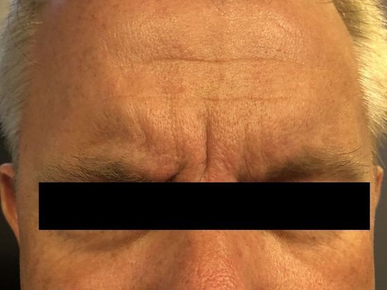 BOTOX® Cosmetic*: Case 2 - Before