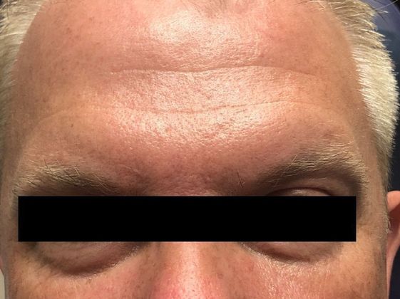 BOTOX® Cosmetic*: Case 2 - After