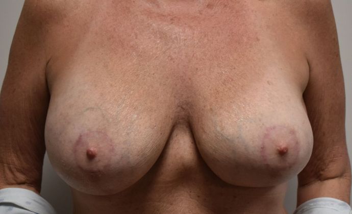 Breast Augmentation w/ Lift Case 292 - After