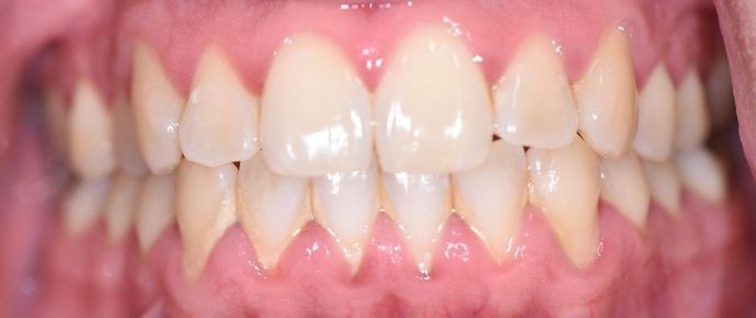 Periodontal Cleaning: Case 2 - Victoria, TX - Before