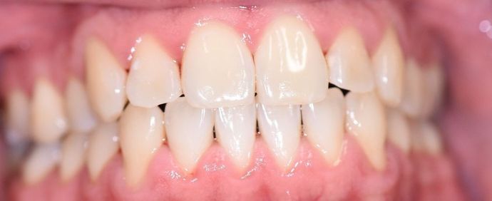 Periodontal Cleaning: Case 2 - Victoria, TX - After