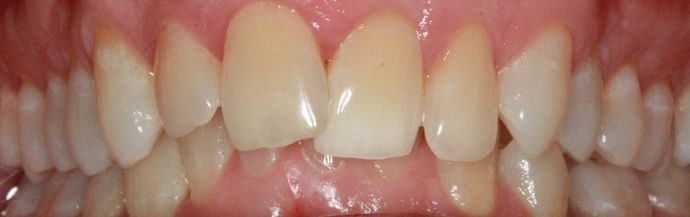 Invisalign Case 1 - Before