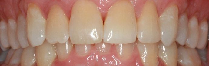 Invisalign Case 1 - After