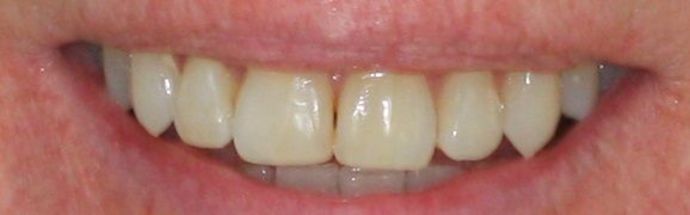 Invisalign Case 2 - After
