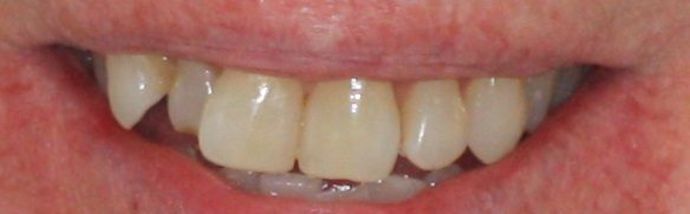 Invisalign Case 2 - Before