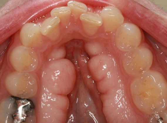 Invisalign Case 3 - Before