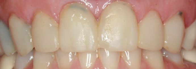 Porcelain Veneers and Crowns Case 1 - Before