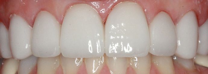 Porcelain Veneers and Crowns Case 1 - After