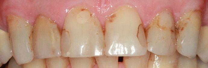 Porcelain Veneers and Crowns Case 2 - Before