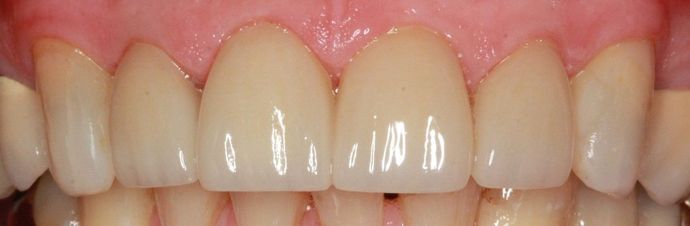 Porcelain Veneers and Crowns Case 2 - After