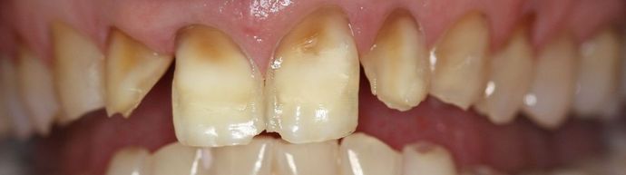 Porcelain Veneers and Crowns Case 3 - Before