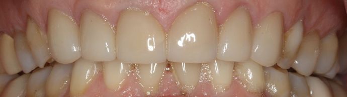 Porcelain Veneers and Crowns Case 3 - After