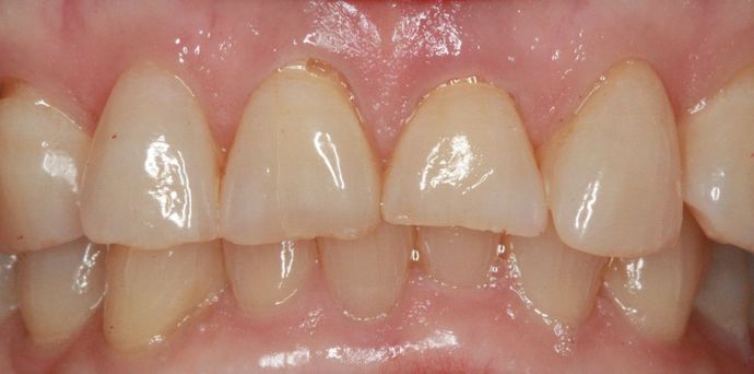 Porcelain Veneers and Crowns: Case 4 - Before