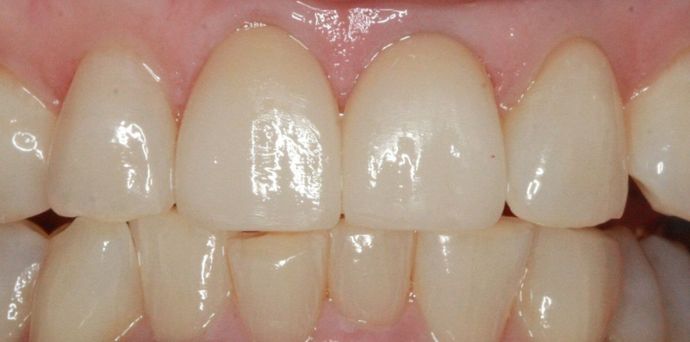 Porcelain Veneers and Crowns: Case 4 - After