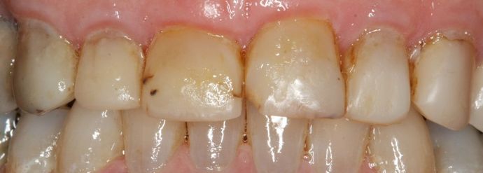 Porcelain Veneers and Crowns Case 5 - Before