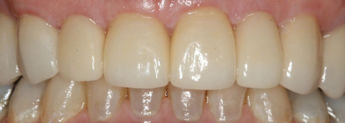 Porcelain Veneers and Crowns Case 5 - After
