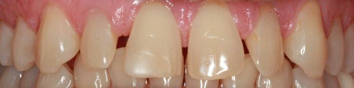 Porcelain Veneers and Crowns: Case 6 - Before