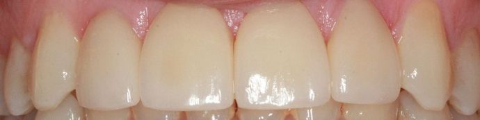 Porcelain Veneers and Crowns: Case 6 - After
