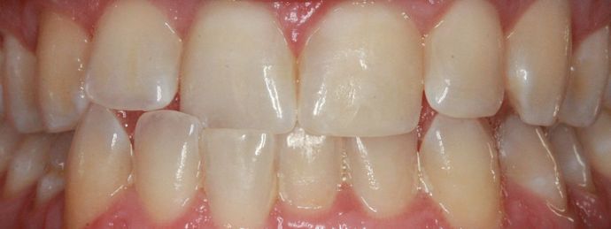 Invisalign Case 4 - Before