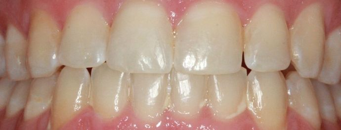 Invisalign Case 4 - After