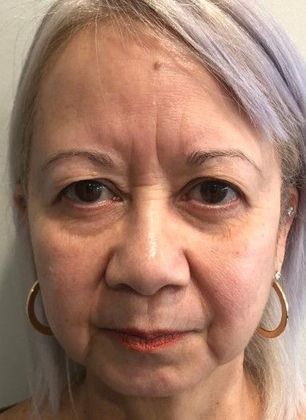 Eyelid Lift: Case 19 Eyelid Lift, Mini Browlift, Stratford, CT - Before