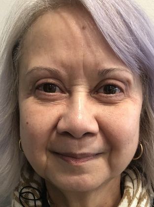 Eyelid Lift: Case 19 Eyelid Lift, Mini Browlift, Stratford, CT - After