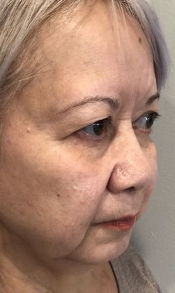 Eyelid Lift: Case 19 Eyelid Lift, Mini Browlift, Stratford, CT - Before