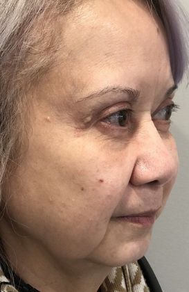 Eyelid Lift: Case 19 Eyelid Lift, Mini Browlift, Stratford, CT - After