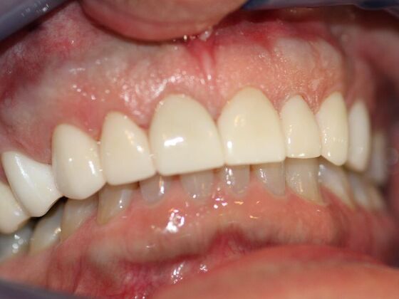 Smile Makeovers, actual cases of our dentists, no special lighting or editing Case 10 - After