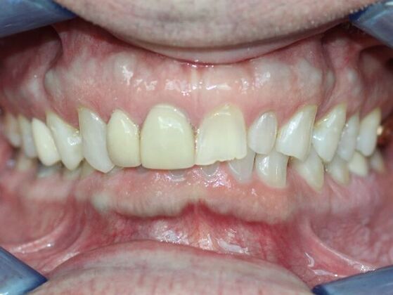 Smile Makeovers, actual cases of our dentists, no special lighting or editing Case 10 - Before