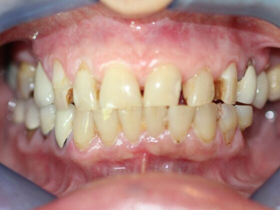 Smile Makeovers, actual cases of our dentists, no special lighting or editing Case 11 - Before