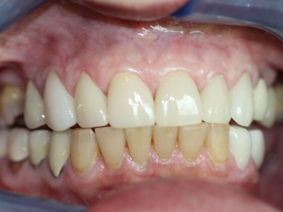 Smile Makeovers, actual cases of our dentists, no special lighting or editing Case 11 - After