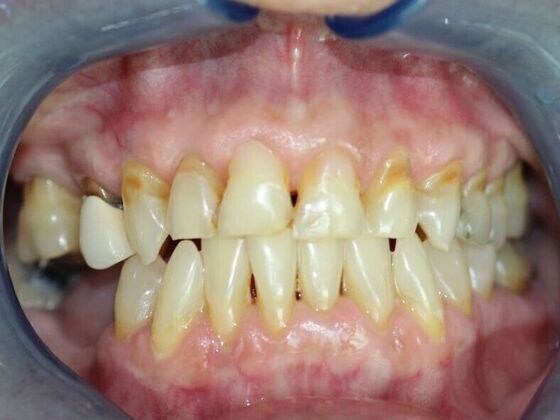 Smile Makeovers, actual cases of our dentists, no special lighting or editing: Case 12 - Before