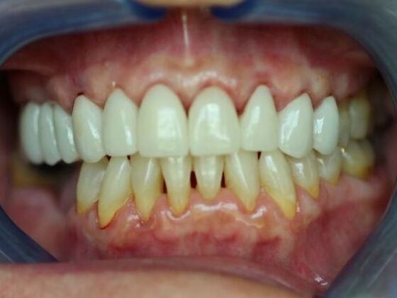 Smile Makeovers, actual cases of our dentists, no special lighting or editing: Case 12 - After
