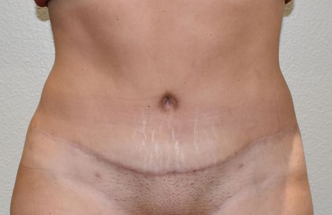 Tummy Tuck (Abdominoplasty): Case 205 - After