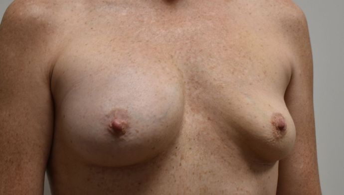 Breast Revision: Case 127 - Before