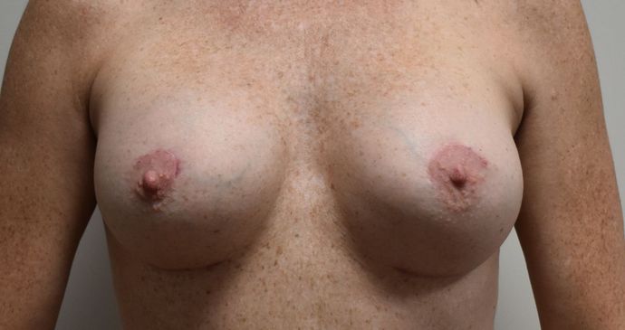 Breast Revision: Case 127 - After