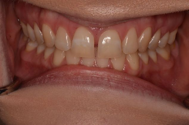 Invisalign Case 11 - Before