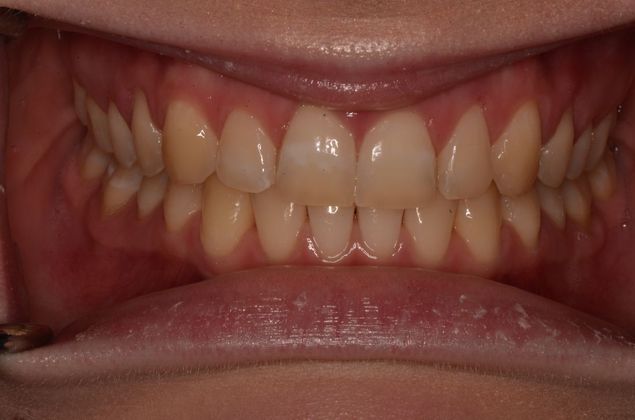 Invisalign Case 11 - After