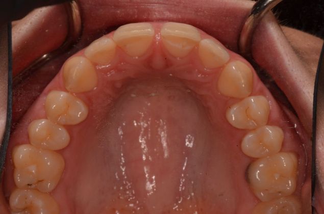 Invisalign: Case 11 - Before invisalign with front space